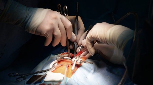 хирурги научились пересаживать мертвые сердца